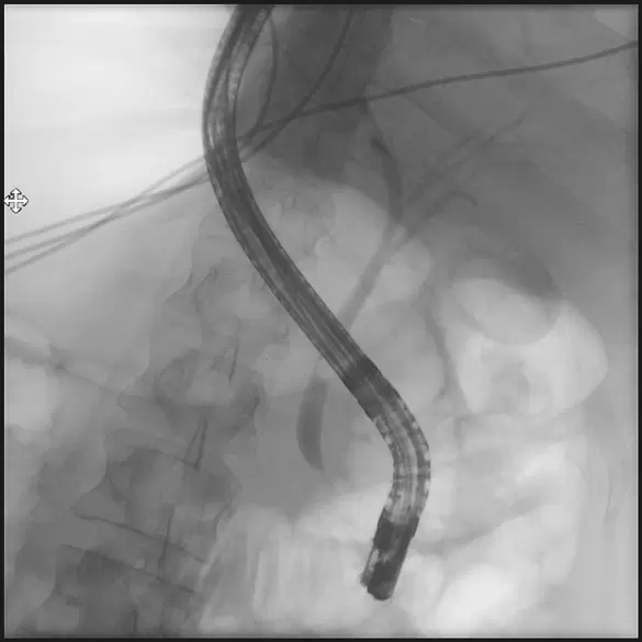 Darstellung Gallengangs- und Bauchspeicheldrüsengang, Gastroenterologie im Josephinum